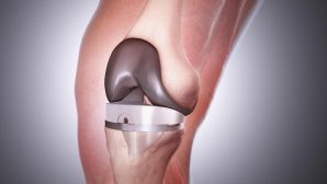 Тест предскажет поможет или нет операция по замене коленного сустава