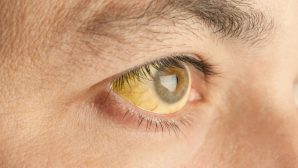 Пожелтение белков глаз может сигнализировать о раке легких