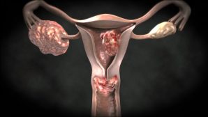 Осторожно: рак матки
